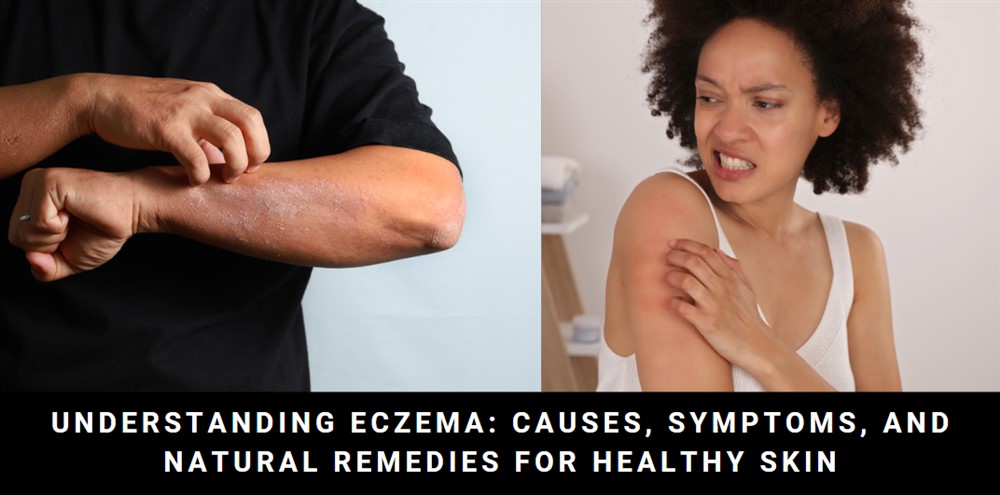 Understanding Eczema: Causes, Symptoms, and Natural Remedies for Healthy Skin