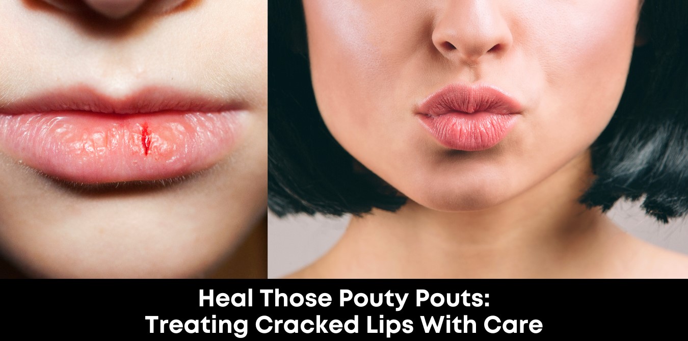 Heal Those Pouty Pouts: Treating Cracked Lips with Care