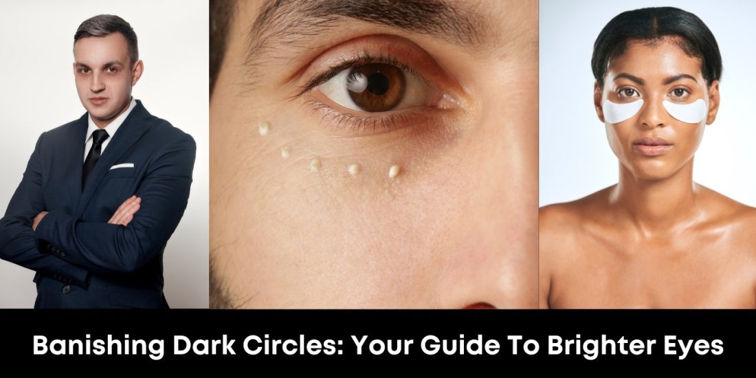 Banishing Dark Circles: Your Guide to Brighter Eyes