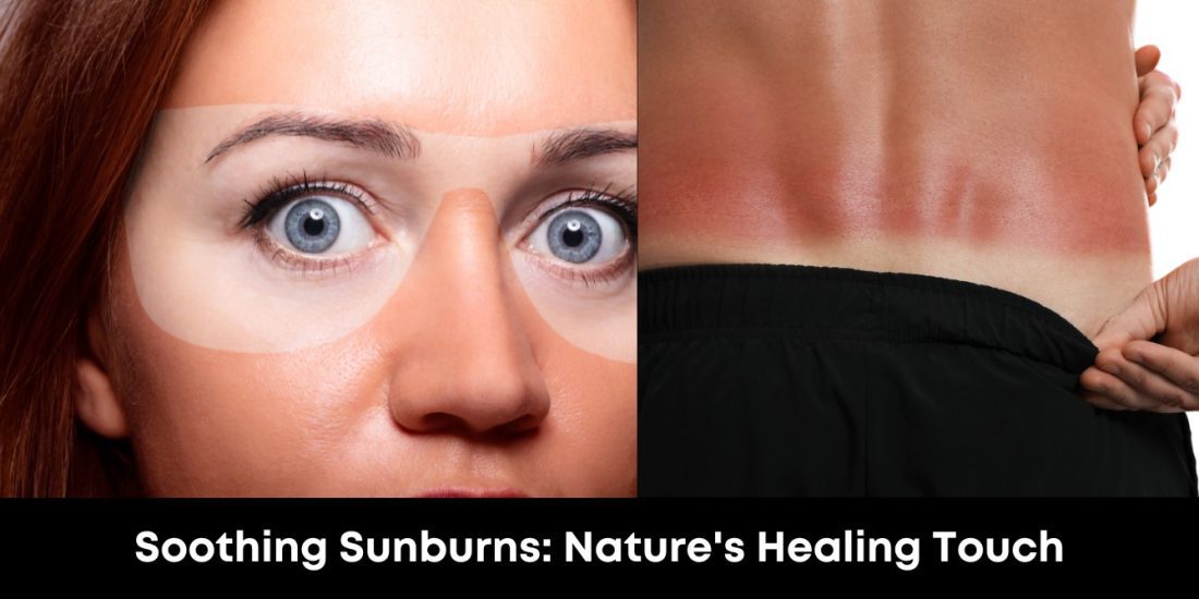Soothing Sunburns: Nature's Healing Touch