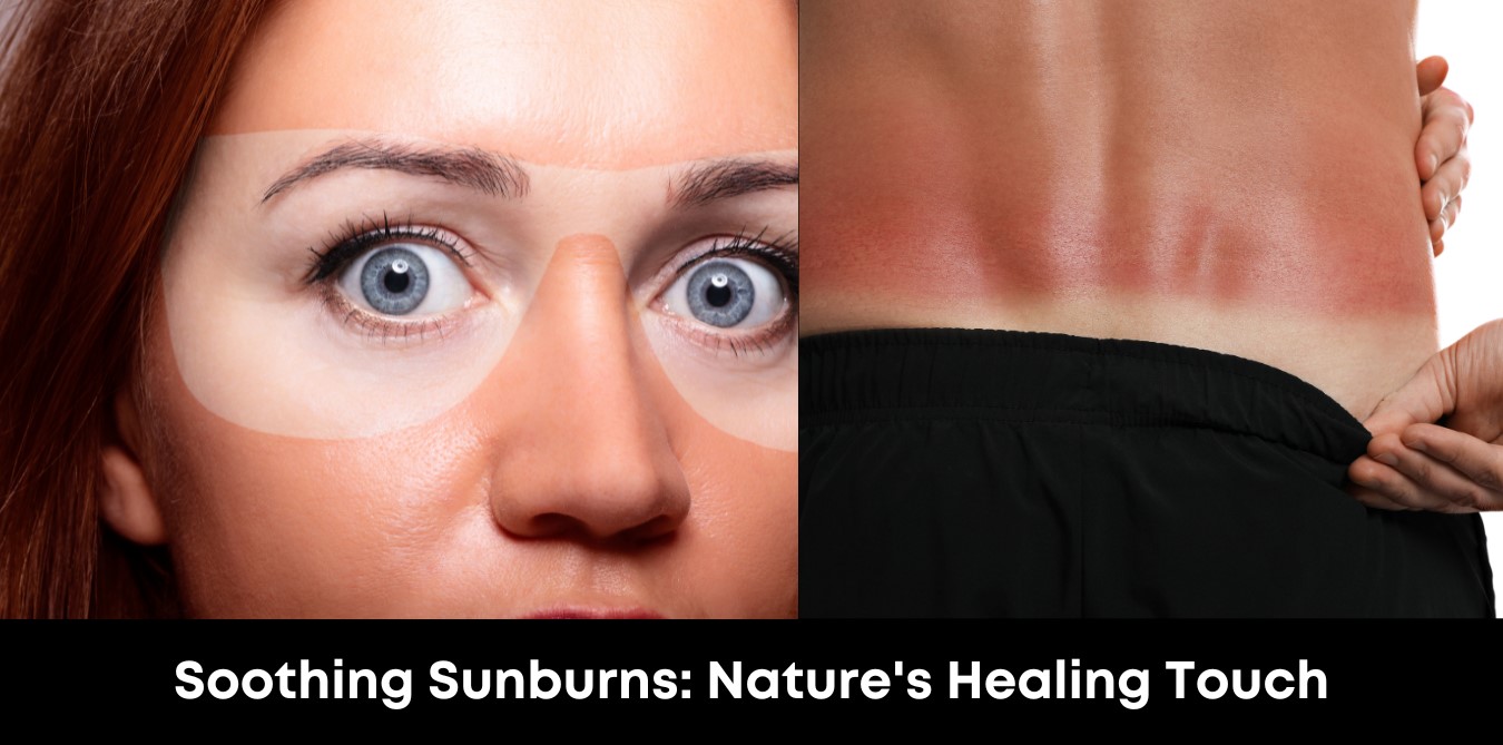 Soothing Sunburns: Nature's Healing Touch