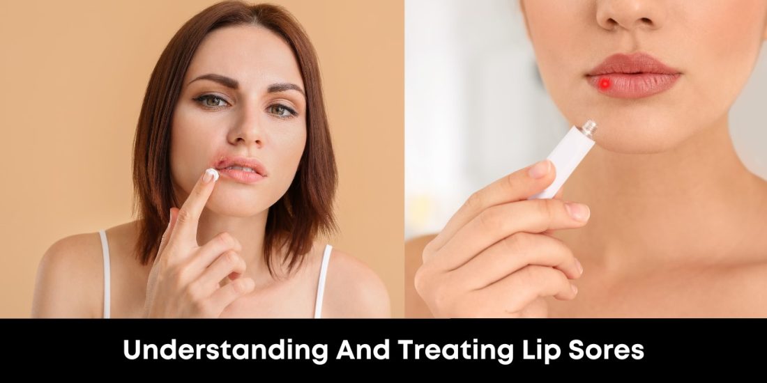 Understanding and Treating Lip Sores