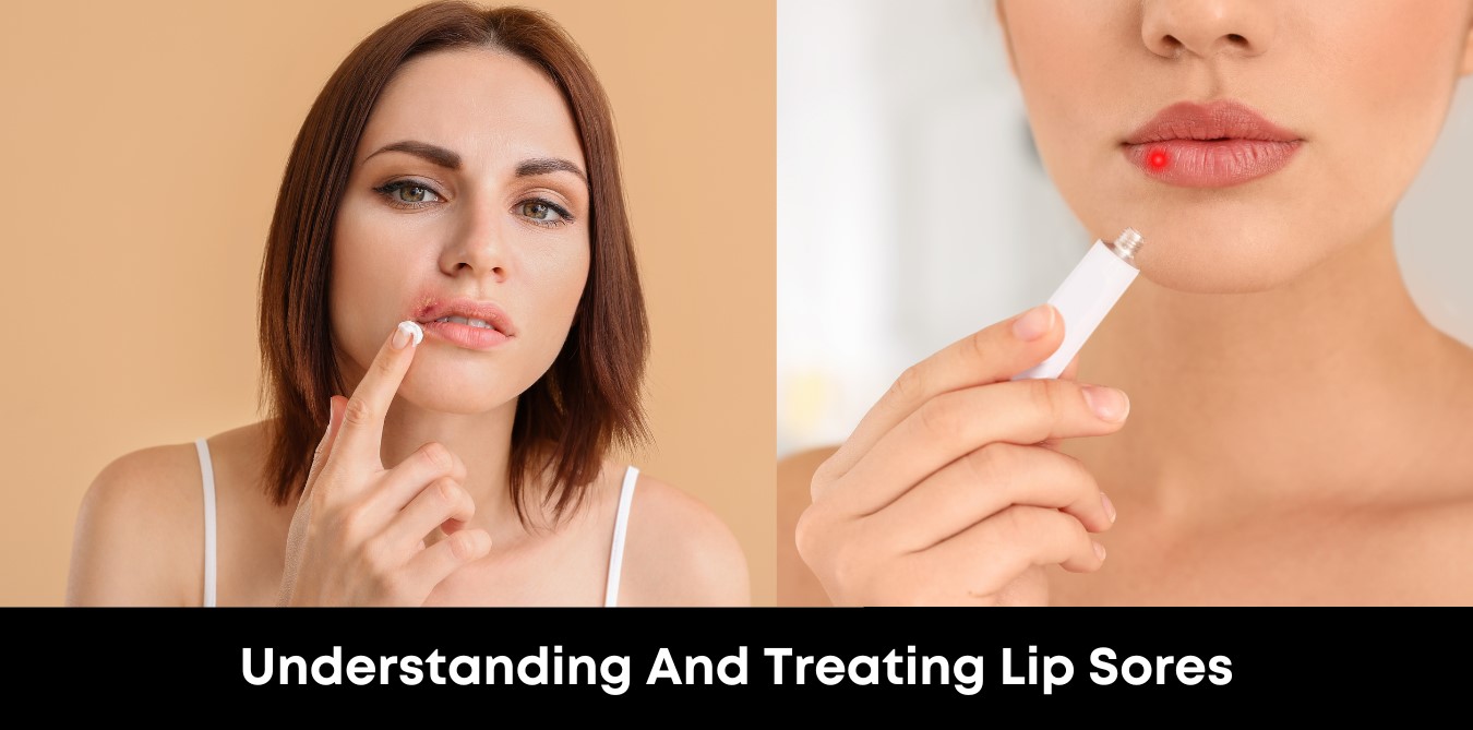 Understanding and Treating Lip Sores
