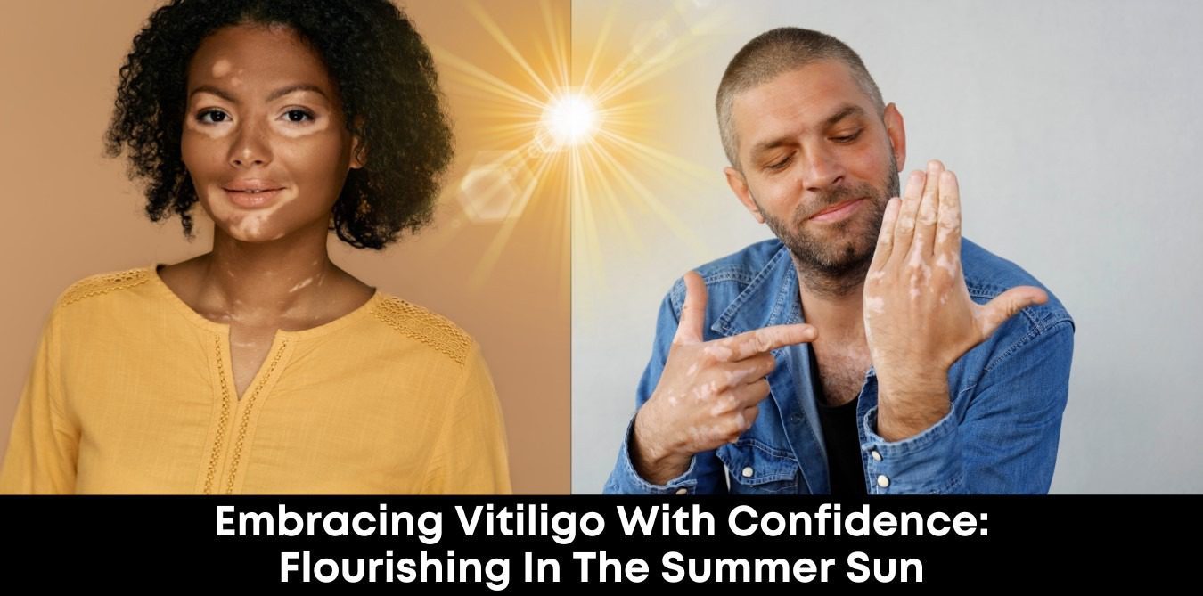 Embracing Vitiligo With Confidence: Flourishing In The Summer Sun